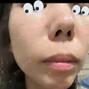 水光注射（ハリ・美肌） / マイクロボトックス DAILY SKIN CLINIC 心斎橋院 DAY 1 サムネイル用