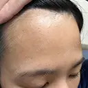 水光注射（ハリ・美肌） / マイクロボトックス DAILY SKIN CLINIC 心斎橋院 DAY 1 サムネイル用