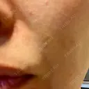 ショッピングリフト BAO CLINIC 梅田院 AFTER サムネイル用