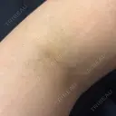 ボトックス（肩） / 高濃度ビタミンC点滴 小倉美容外科/美容皮膚科 ビラビューティークリニック DAY 4 サムネイル用