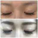 二重埋没 湘南美容クリニック 新宿南口院 DAY 71 サムネイル用