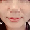 糸リフト 福岡TAクリニック AFTER サムネイル用