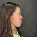 ボトックス（あご） / ヒアルロン酸注入（あご） / ボトックス（眉間） / ヒアルロン酸注入（鼻翼基部） HAAB×DREAM BEAUTY CLINIC 大阪梅田院 AFTER サムネイル用