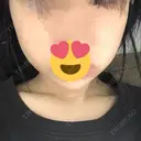 ボトックス（あご） / ヒアルロン酸注入（あご） / ボトックス（エラ・小顔） SUNMELIA SKIN CLINIC DAY 2 サムネイル用