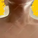 ボトックス（肩） 大美会クリニック 京都烏丸院 AFTER サムネイル用