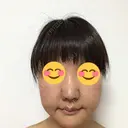 鼻尖形成（切開） / 小鼻縮小（切開） / 鼻尖縮小 湘南美容クリニック 神戸院 DAY 22 サムネイル用