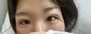 二重埋没 / ヒアルロン酸注入（涙袋） / ハイフ（顔） TCB東京中央美容外科 札幌駅前院 DAY 6 サムネイル用