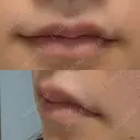 ヒアルロン酸注入（唇） / ボトックス（口角） ルラ美容クリニック 大阪心斎橋院 AFTER サムネイル用