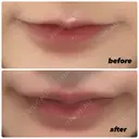 ヒアルロン酸注入（唇） / ボトックス（口角） ルラ美容クリニック 大阪心斎橋院 DAY 7 サムネイル用