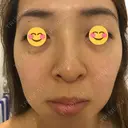 水光注射（ハリ・美肌） / ハイフ（顔） シロアム韓方美容・ダイエットクリニック(美&EYE) DAY 8 サムネイル用