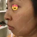 水光注射（ハリ・美肌） / ハイフ（顔） シロアム韓方美容・ダイエットクリニック(美&EYE) DAY 8 サムネイル用