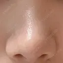 鼻尖形成（切開） / 軟骨移植 アネシス美容クリニック DAY 16 サムネイル用