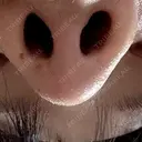 鼻尖形成（切開） / 軟骨移植 アネシス美容クリニック DAY 16 サムネイル用