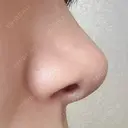 鼻尖形成（切開） / 軟骨移植 アネシス美容クリニック DAY 20 サムネイル用