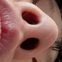 鼻尖形成（切開） / 軟骨移植 アネシス美容クリニック DAY 20 サムネイル用