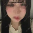 ボトックス（あご） / ヒアルロン酸注入（あご） / ボトックス（エラ・小顔） SUNMELIA SKIN CLINIC AFTER サムネイル用