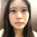 ヒアルロン酸注入（涙袋） 共立美容外科 梅田院 AFTER サムネイル用