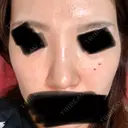 鼻尖形成（切開） / 鼻中隔延長（切開） / 脂肪溶解注射 / ボトックス（肩） / その他（鼻） エートップ美容整形外科 AFTER サムネイル用