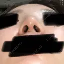 鼻尖形成（切開） / 鼻中隔延長（切開） / 脂肪溶解注射 / ボトックス（肩） / その他（鼻） エートップ美容整形外科 DAY 56 サムネイル用