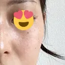 ピーリング（ハリ・ツヤ） / ルメッカ PureMe Skin Clinic（ピュアミースキンクリニック麻布） DAY 0 サムネイル用