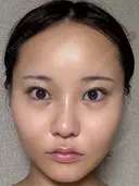 糸リフト / 脂肪吸引注射（顔） 札幌美容外科ネビュラクリニック DAY 7 サムネイル用