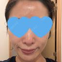光治療（フォトフェイシャルなど） RainBoW Clinic TOKYO DAY 0 サムネイル用