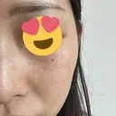 ピーリング（ハリ・ツヤ） / ルメッカ PureMe Skin Clinic（ピュアミースキンクリニック麻布） DAY 1 サムネイル用