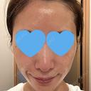 光治療（フォトフェイシャルなど） RainBoW Clinic TOKYO DAY 1 サムネイル用