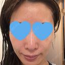 光治療（フォトフェイシャルなど） RainBoW Clinic TOKYO AFTER サムネイル用