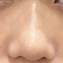 鼻尖形成（切開） / 小鼻縮小（切開） / 軟骨移植 ブルームクリニック（BLOOM CLINIC） DAY 87 サムネイル用