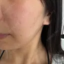 ほくろ・いぼ切除（肌） KARIS beauty clinic AFTER サムネイル用