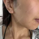 ほくろ・いぼ切除（肌） KARIS beauty clinic DAY 220 サムネイル用