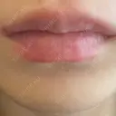 ヒアルロン酸注入（唇） ziz CLINIC AFTER サムネイル用