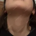 ハイフ（顔） AZ BEAUTY CLINIC DAY 12 サムネイル用