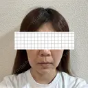 バッカルファット除去 アリエル美容クリニック 大宮院 DAY 20 サムネイル用