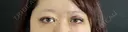 二重埋没 / 眼瞼下垂（切開） / 上まぶたの脂肪取り 藤・ナチュレ美容クリニック 銀座院 DAY 7 サムネイル用