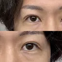 二重埋没 けやき美容クリニック 沼津院 DAY 14 サムネイル用