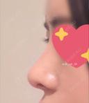 鼻尖形成（切開） / 鼻中隔延長（切開） / 軟骨移植 / 眉間プロテーゼ / 鼻修正 ミナ美容外科 DAY 91 サムネイル用