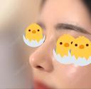 鼻尖形成（切開） / 鼻中隔延長（切開） / 軟骨移植 / 眉間プロテーゼ / 鼻修正 ミナ美容外科 DAY 91 サムネイル用