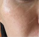 イオン導入 / ピーリング（ハリ・ツヤ） / ルメッカ ルラ美容クリニック 名古屋栄院 / ルラスキンクリニック 名古屋栄院 DAY 4 サムネイル用