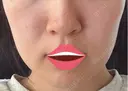 脂肪吸引（顔） 湘南美容クリニック 渋谷院 DAY 32 サムネイル用