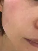 毛穴洗浄（ハイドラフェイシャルなど） / ルメッカ ON-CLINIC Beauty DAY 0 サムネイル用