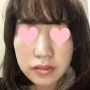 小鼻縮小（切開） JUN CLINIC AFTER サムネイル用