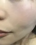 毛穴洗浄（ハイドラフェイシャルなど） / ルメッカ ON-CLINIC Beauty DAY 1 サムネイル用