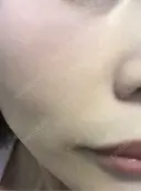 毛穴洗浄（ハイドラフェイシャルなど） / ルメッカ ON-CLINIC Beauty DAY 1 サムネイル用