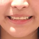 セラミック / その他（審美歯科/矯正歯科） 東京美容外科 赤坂院 DAY 6 サムネイル用
