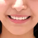 セラミック / その他（審美歯科/矯正歯科） 東京美容外科 赤坂院 AFTER サムネイル用