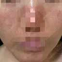 ニードルRF（ポテンツァなど） ながしま形成外科クリニック DAY 0 サムネイル用