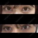 二重埋没 Stand by Beauty Clinic DAY 15 サムネイル用