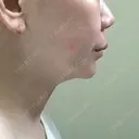 脂肪溶解注射（顔） 麻布十番クレールデンタルクリニック DAY 2 サムネイル用